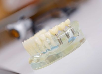 Zahnimplantate – langlebiger Zahnersatz vom Spezialisten in Salzgitter Moderne Zahnimplantate im Zahnzentrum Dr. Parusel & Kollegen in Salzgitter